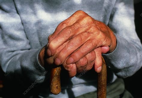 Arthritic hands - Stock Image - M110/0441 - Science Photo ...