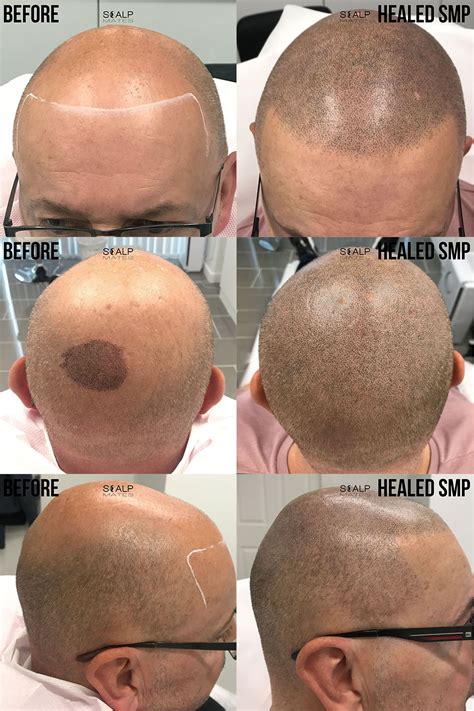Amazing Result Scalp Micropigmentation Smp Before And After