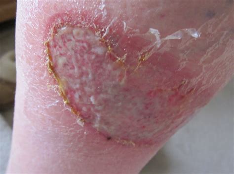 Maybe you would like to learn more about one of these? 2nd Degree Sunburn Second degree burn - sfx Images - Frompo