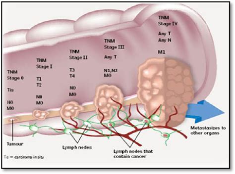 Figure 2 From A Review On Colorectal Cancer Semantic Scholar