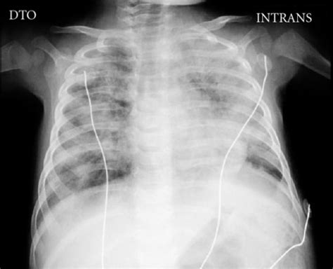 Severe Combined Immunodeficiency Scid Concise Medical Knowledge