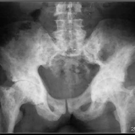 An Ap Radiograph Of Pelvis From A Patient With Known Multiple