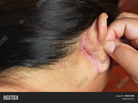 Wound Behind Ear Image And Photo Free Trial Bigstock