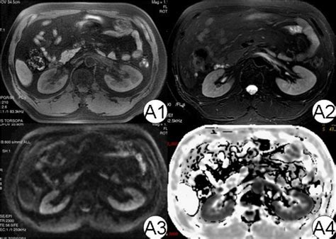 Mri Diagram Of Normal Kidney In The Picture A1 To A4 Are T1wi T2wi