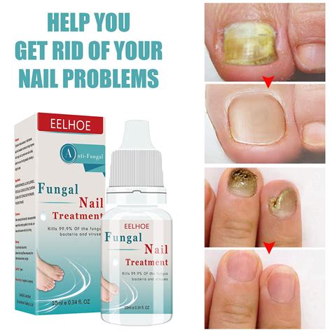 Fungal Nail Treatment Serum Onychomycosis Paronychia Anti Fungal Nail Infection Herbal Toe