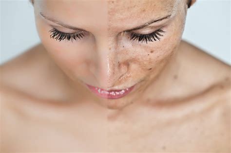 Cosmelan Depigmentation Treatment Authorized Usa Store Skin By Kataryna
