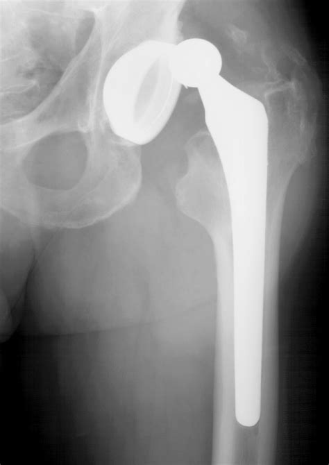 Late Instability Following Total Hip Arthroplasty