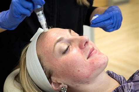 My Microneedling Experience Did It Work For Acne Scars The Gem