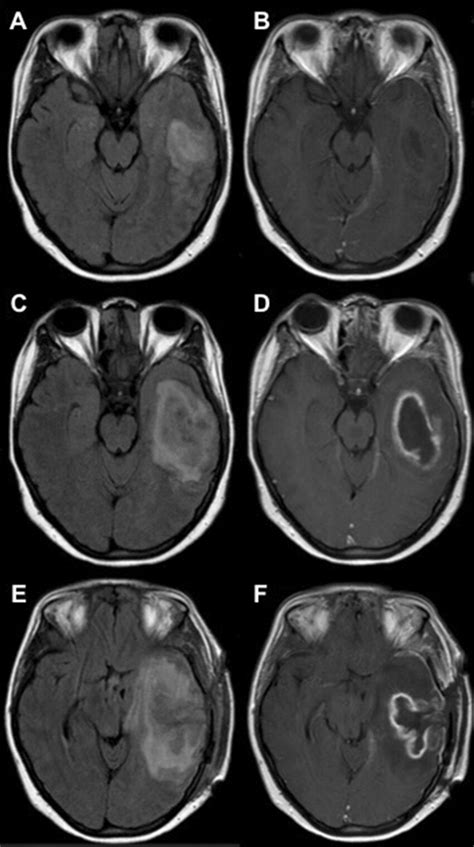 A Early Cerebritis Axial Fluid Attenuated Inversion Recovery