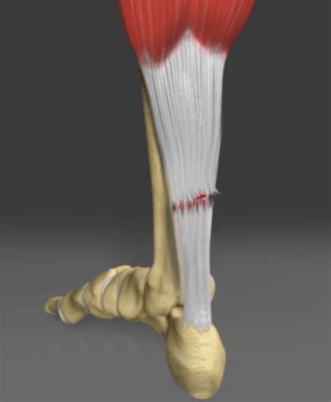 Achilles Tendon Repair Bunbury Foot And Ankle Surgeon