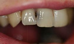 I got them cleaned at the dentist with some kind of powdery water that they sprayed on my teeth. Smile Gallery | Alan R. DeAngelo, DDS