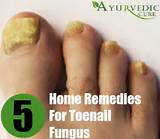 Photos of Bleach Toenail Fungus Home Remedies