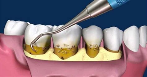 Curetaje Dental ¿qué Es Y Cuándo Se Realiza