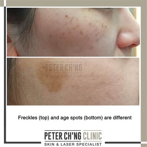 Age Spots Not Necessarily Due To Old Age Peter Chng Clinic Skin