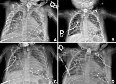 High Volume Bilateral Chylothorax Presenting With Hypoxemia And Shock