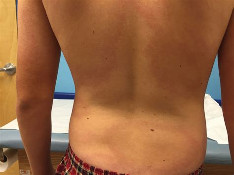 A 13 Year Old Boy Presents With Red Annular Rash On Torso Thighs
