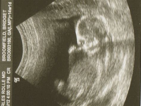 Broomﬁeld Baby Blog Sonogram From 14 Weeks 1 Day