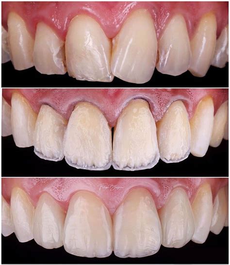 What Is The Difference Between Composite Veneers And Porcelain Veneers