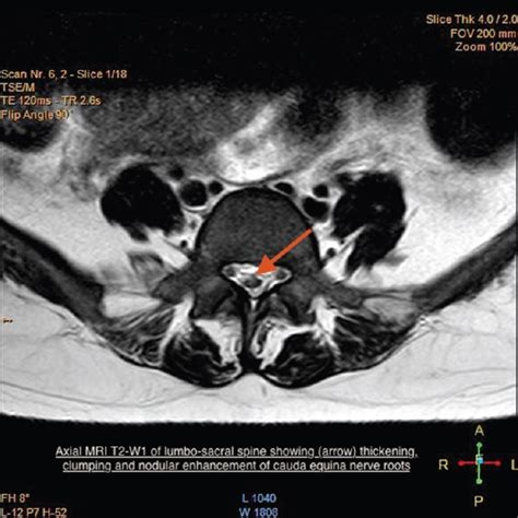 Post Procedure Adhesive Arachnoiditis Following Obstetric Spinal