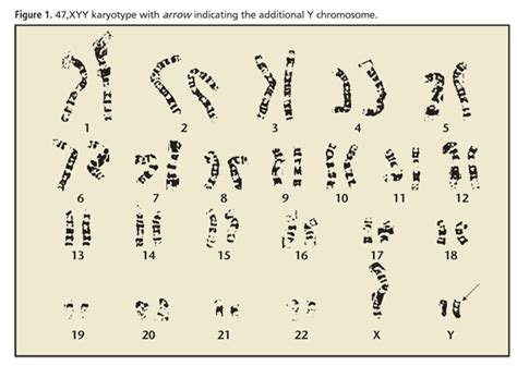 Jacobs Syndrome Karyotype