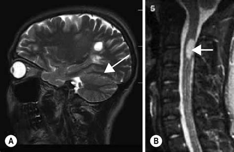 An Mri Image Showing Ms Lesions In The Brain A And Free Download Nude Photo Gallery