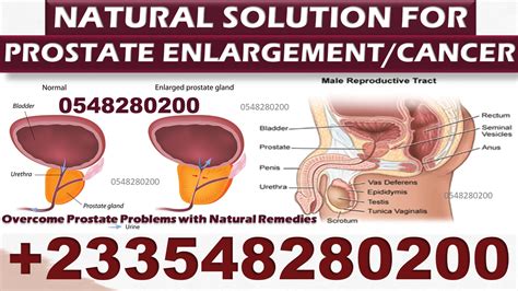 Natural Prostate Enlargement Pack Healths Links