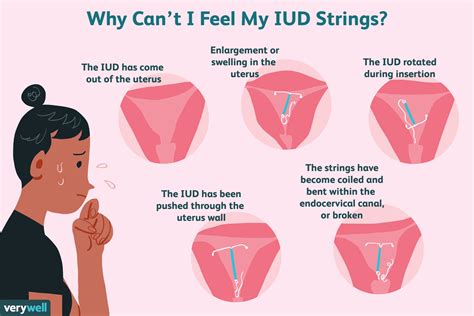 What To Do If Your Iud Strings Seem To Be Missing