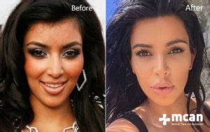 Kim Kardashian S Plastic Surgery Journey Mcan Health