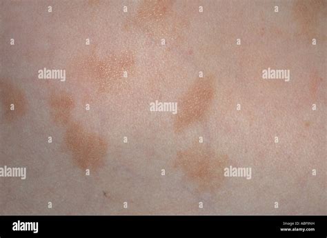 Mastocytosis Hi Res Stock Photography And Images Alamy