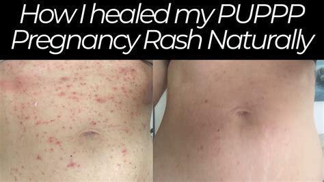 Pruritic Urticarial Papules And Plaques Of Pregnancy First Trimester