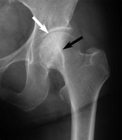 Radiograph Of The Left Hip Joint At 12 Months After The Open I