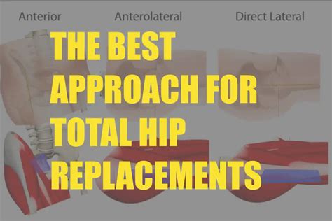 What Is The Best Approach For Total Hip Replacements Dr Chien Wen Liew