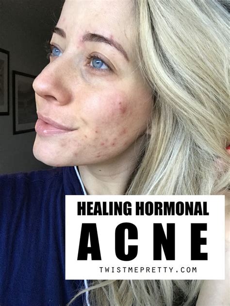 My Anti Aging Acne Prone Skincare Routine Twist Me Pretty Acne