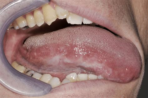 A Flat Leukoplakia On Lateral Tongue Download Scientific Diagram