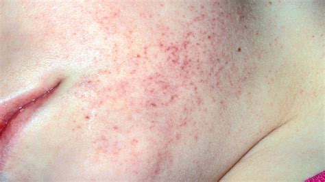 Petechiae When To Worry Causes Symptoms And More Serious Health