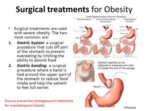 Gastric Weight Loss Surgery Procedure Risks Recovery Effects