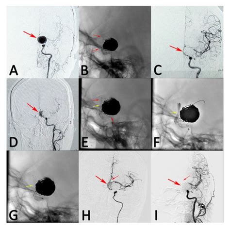 A Patient With Left Giant Posterior Communicating Artery Aneurysm Was Download Scientific