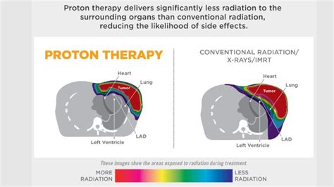 Proton Therapy For Treating Left Sided Breast Cancer Plays A Crucial Part In Sparing Damage To