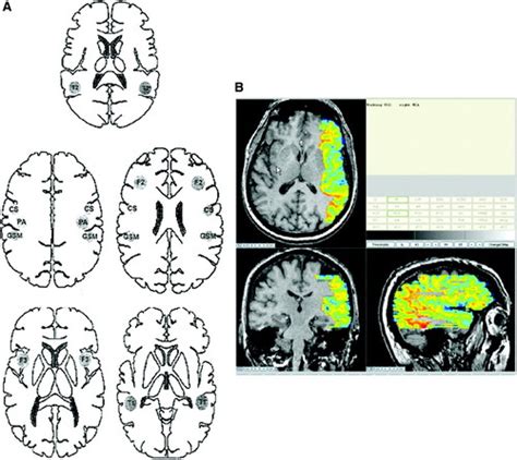 Failure Of Cerebral Hemodynamic Selection In General Or Of Specific