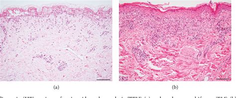 Figure 1 From Immunohistopathological Findings Of Severe Cutaneous