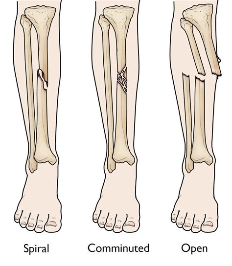 Tibia Fracture Types
