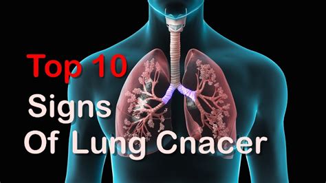 Top 10 Early Signs Of Lung Cancer You Should Cant Ignore These Signs