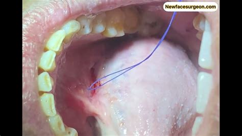Salivary Gland Duct Stone Removal Youtube