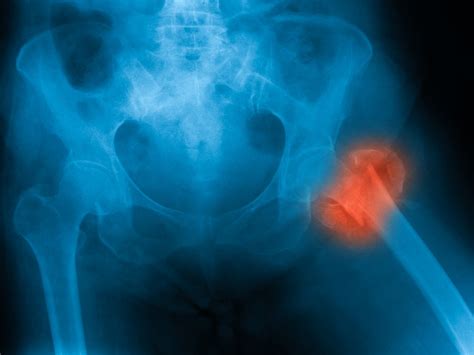 One Third Of Canadian Patients Get Hip Fracture Repair Within 24 Hours
