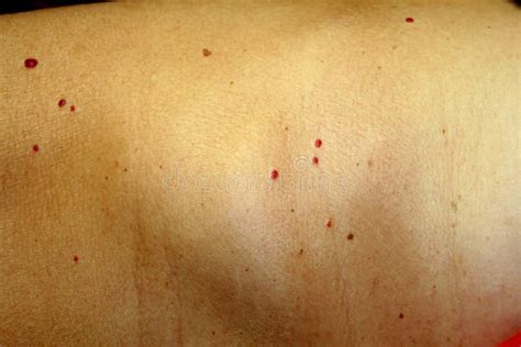 Angioma On The Skin Red Moles On The Body Many Birthmarks Stock