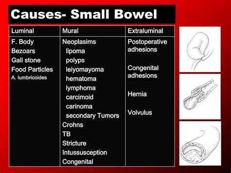 Ppt Intestinal Obstruction Powerpoint Presentation Free Download