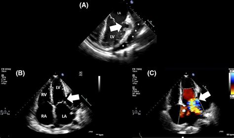 Cardiovascular Imaging In Infective Endocarditis Circulation