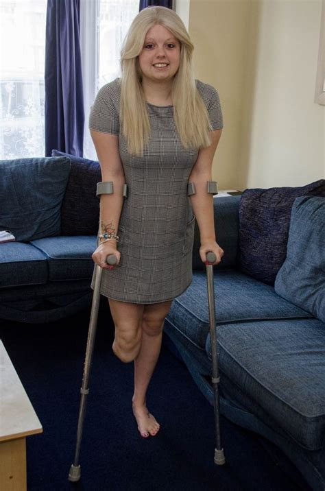 Teenage Hairdresser Lost Her Leg After Doctors Dismissed Her Melon Like
