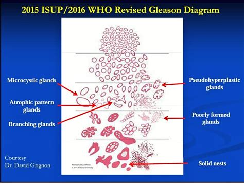 Gleason Pattern 4 Human Pathology