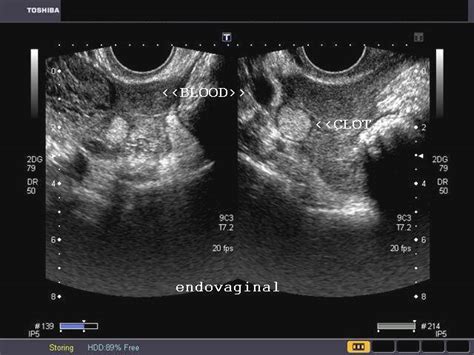 Transvaginal Ultrasound Ovarian Cysts